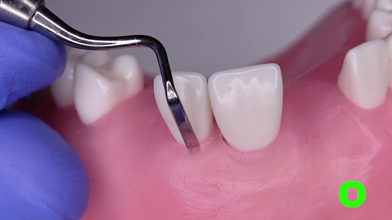 Intrasulcular Incision Technique - Don't Incise Papillae