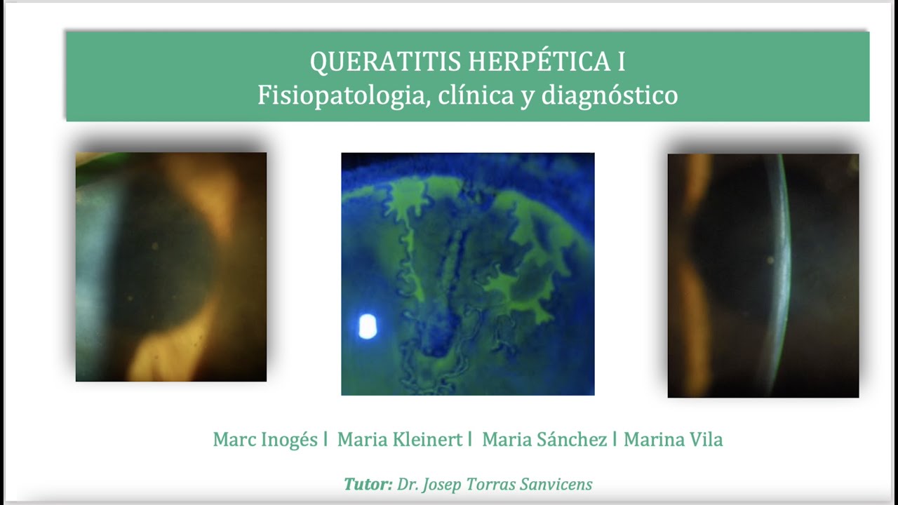 Fisiopatología, Clinica y Diagnóstico de la Queratitis Herpética. Queratitis Herpética I.