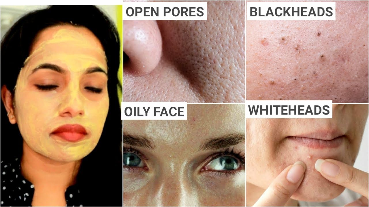 ಎಷ್ಟೇ ಹಳೆಯ OPEN PORES, LARGE PORES, CLOGGED PORES  ಇದ್ದರು 100% ಹೋಗತ್ತೆ | Oily Skin | BLACKHEADS