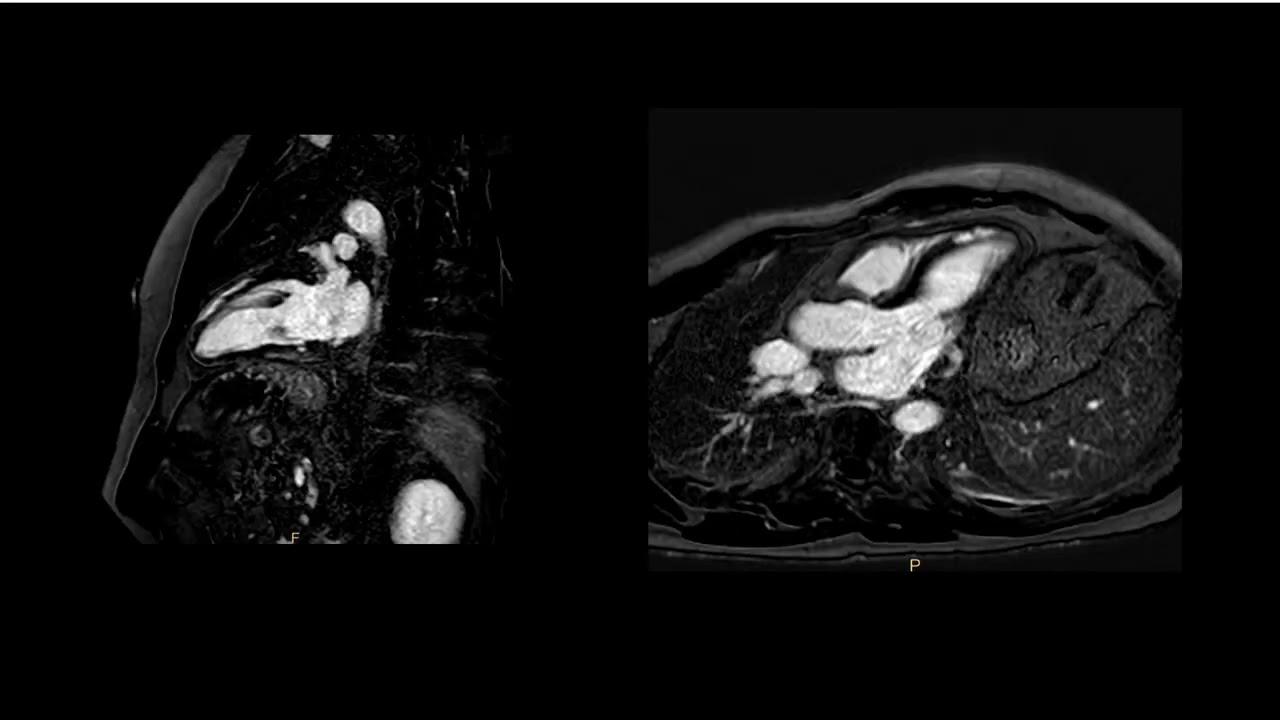CMR assessment of Myocarditis