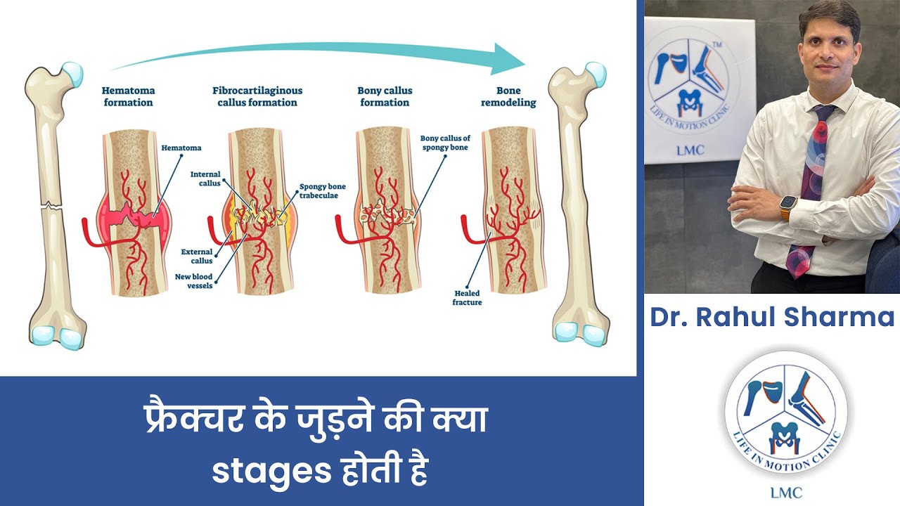 फ्रैक्चर के जुड़ने की प्रक्रिया:जानें कैसे हड्डी अपने आप ठीक होती है! | fracture Healing full detail