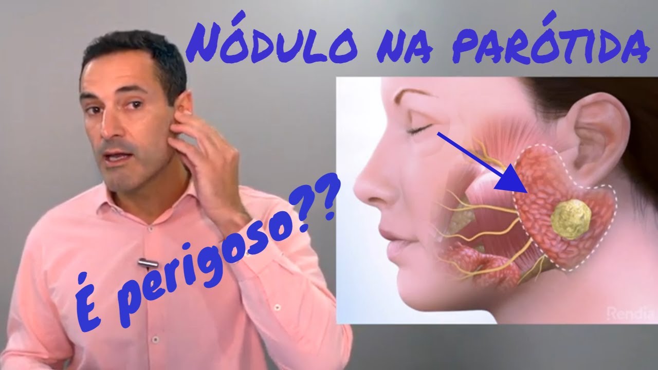 Nódulo na parótida: o que pode ser um nódulo da glândula parótida