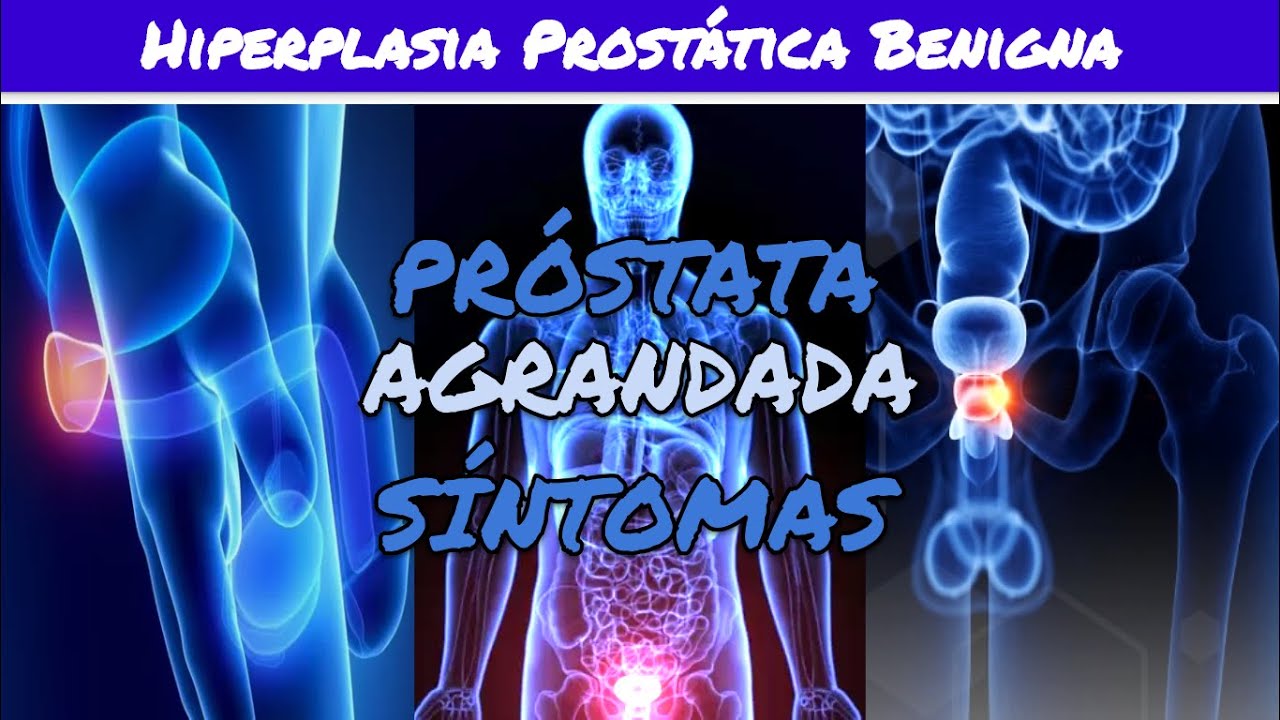 ⚕️🩺 AGRANDAMIENTO DE PRÓSTATA o Hiperplasia Prostática Benigna: Síntomas y Tratamiento