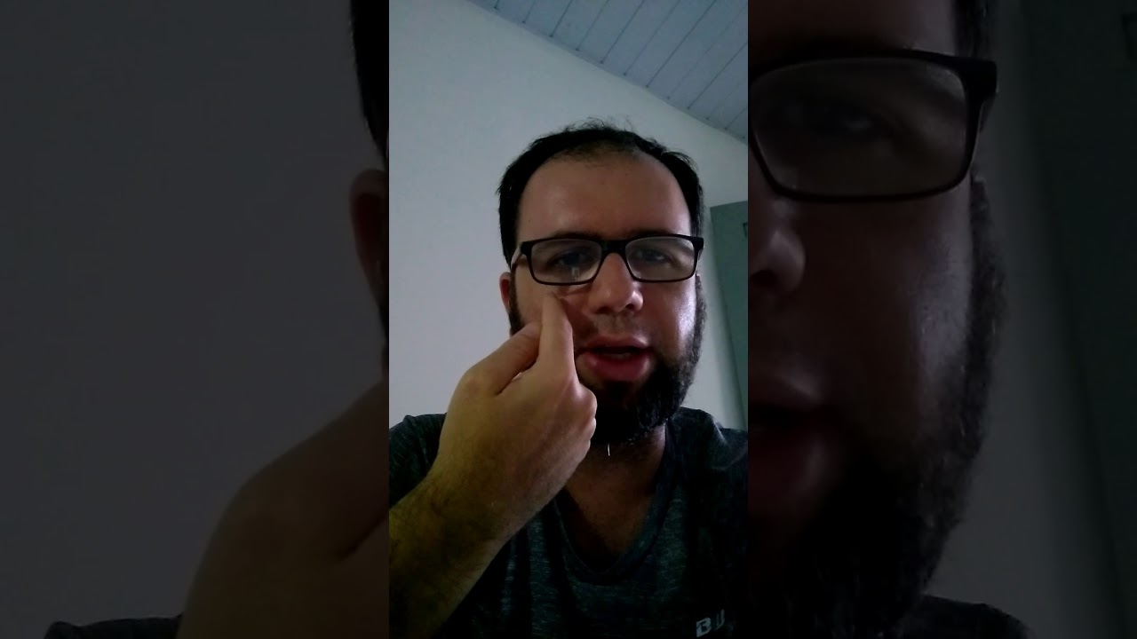 7° dia da cirurgia de desvio de septo nasal sinusectomia e turbinectomia.