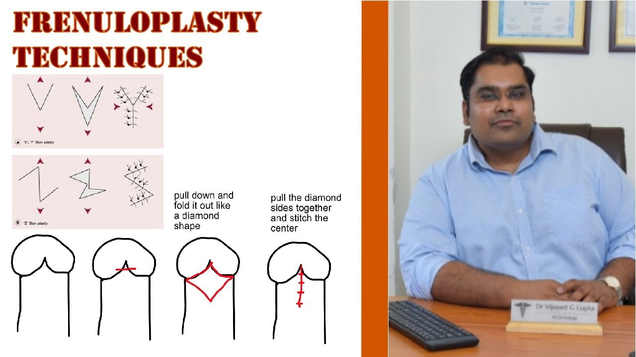 Frenulopasty techniques for Frenulum Breve - VY Plasty, Z Plasty, Stitchless