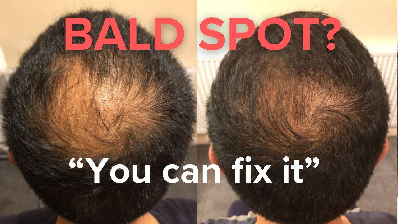 Reverse Hair Loss on the Crown