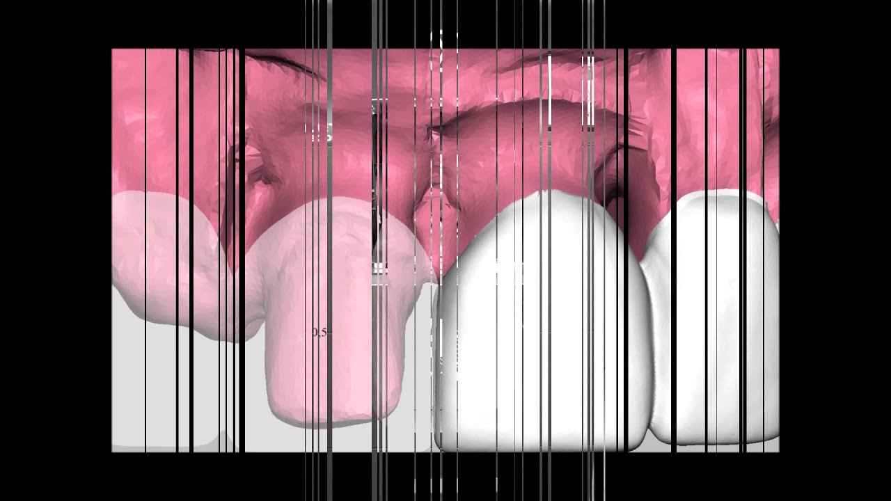 Ponti e Corone Lumineers "Laboratorio DenMat Italia"