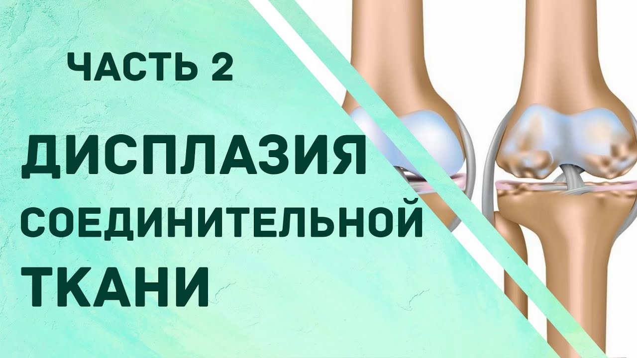 Дисплазия соединительной ткани (часть 2)
