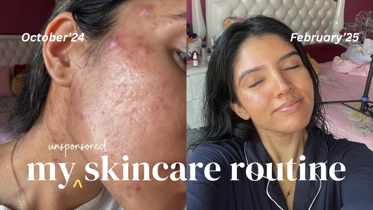 My *UNSPONSORED* Skincare Routine for Acne, Eczema & Sensitive Skin