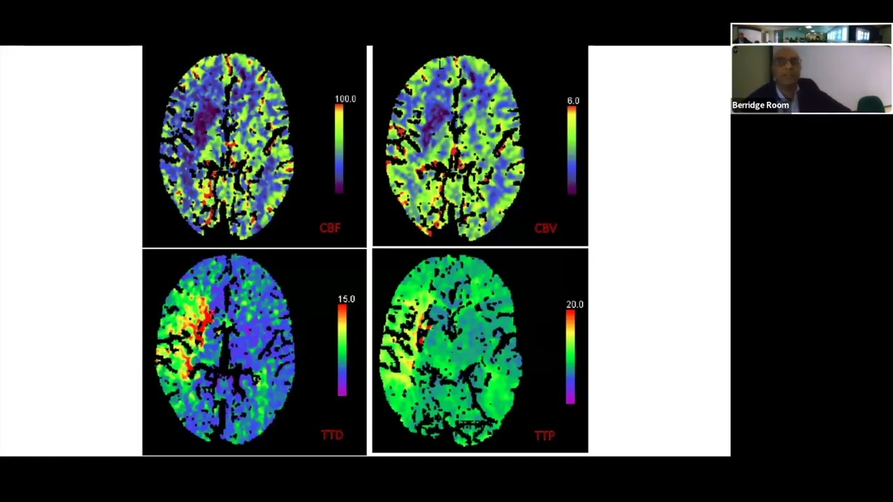 'Expanding the Role of Mechanical Thrombectomy for Stroke' by Dr Yogish Joshi