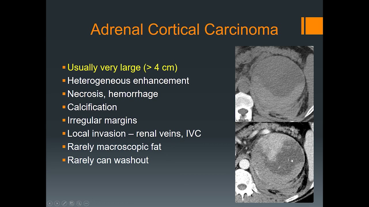 Imaging of adrenal gland