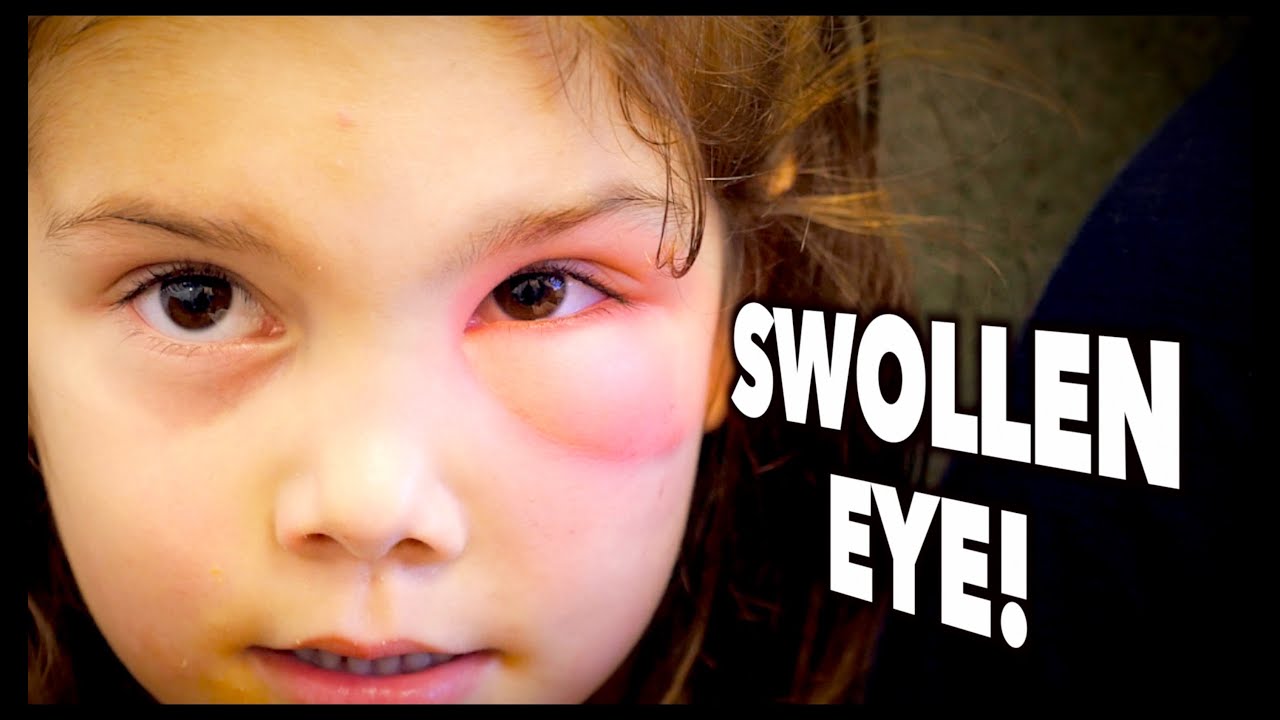 SWOLLEN EYE! (Periorbital Cellulitis?) | Dr. Paul