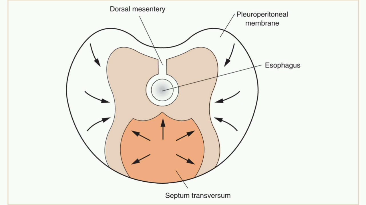 Bochdalek hernia congenital diaphragmatic hernia