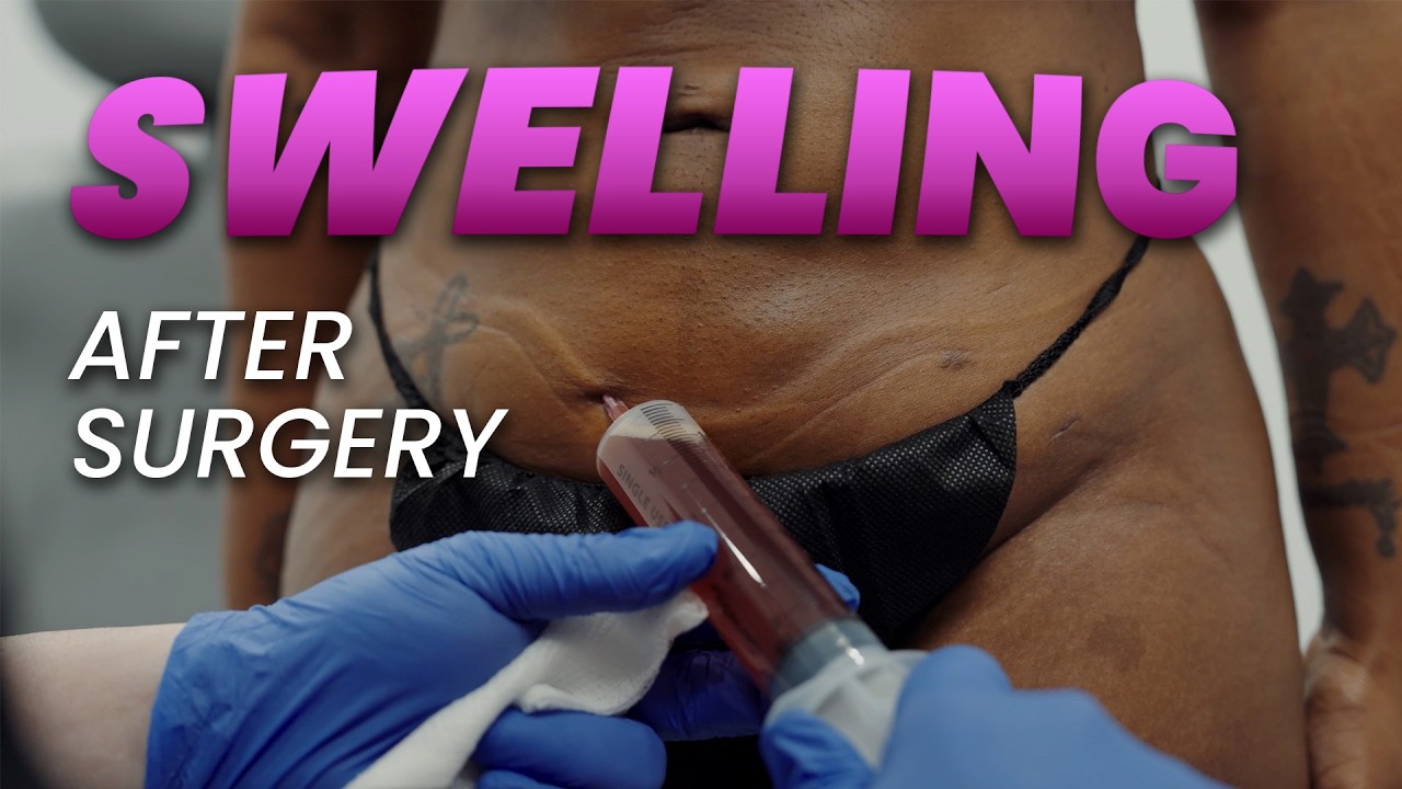 Отек после пластической хирургии: о чем вам НИКТО не расскажет.