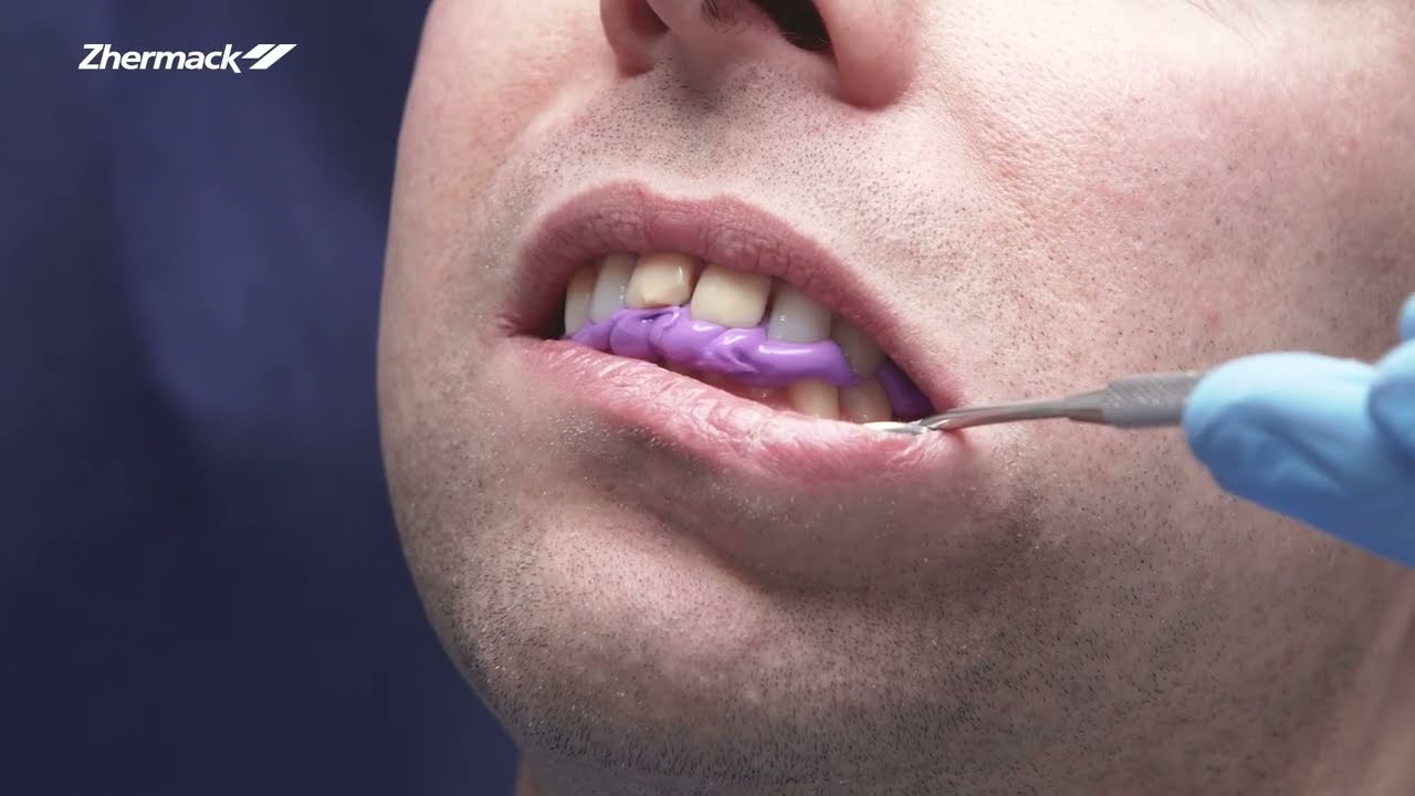 Dental Clinical Procedure for Provisional Crown Restoration - Chapter 2: Bite Registration