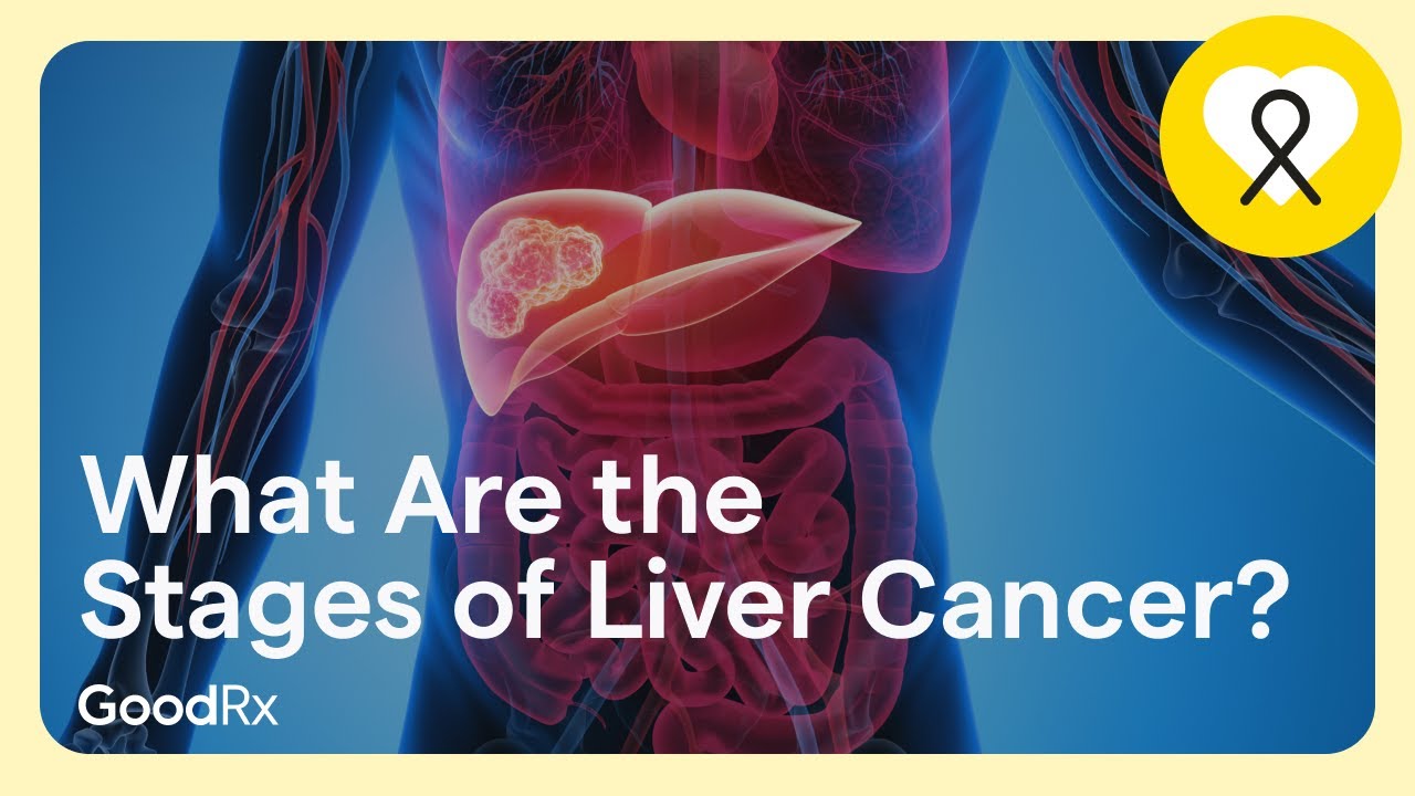 What Are the Stages of Liver Cancer? | GoodRx