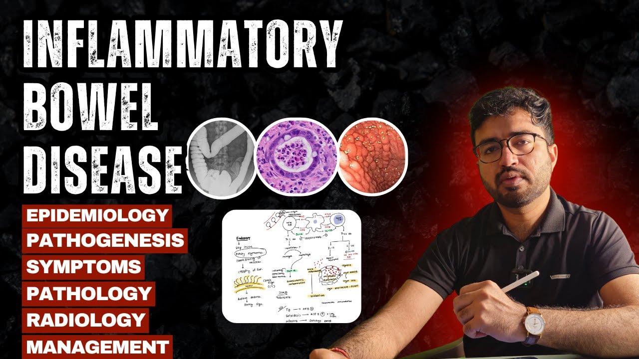 Воспалительные заболевания кишечника (ВЗК) | Болезнь Крона и язвенный колит | Всё в одной лекции