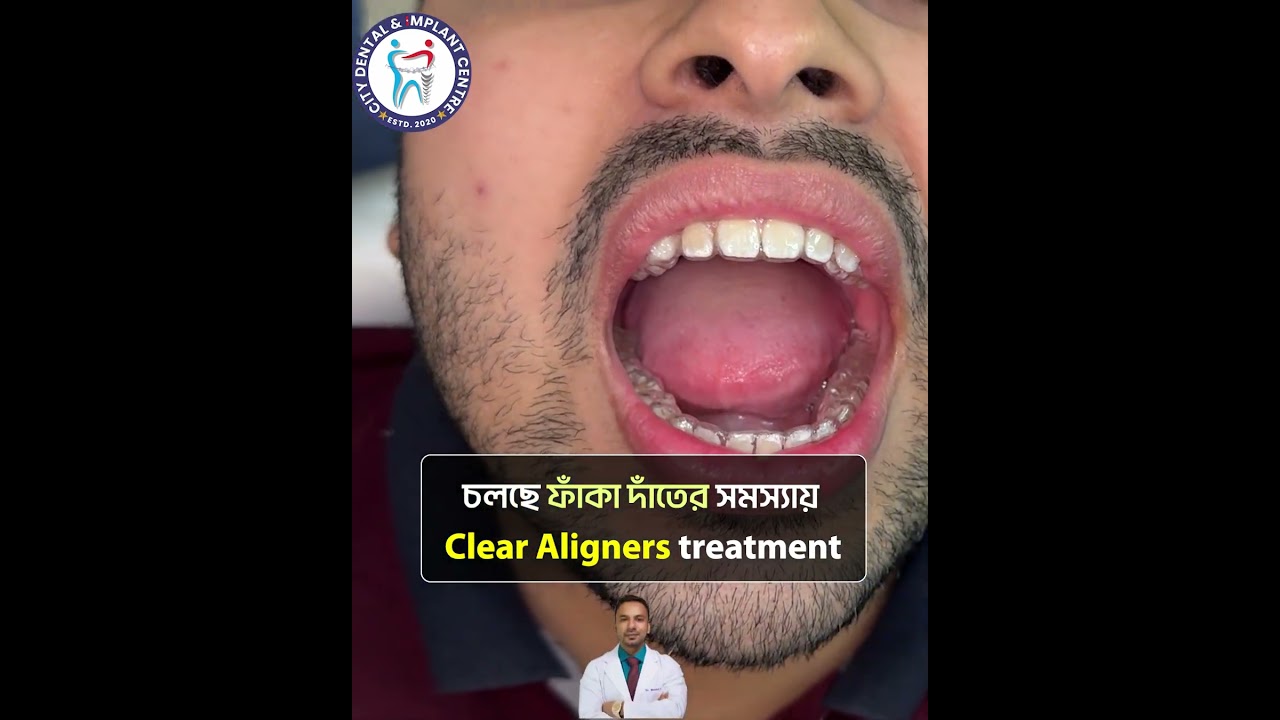 ব্রেসেস ছাড়াই দাঁত সোজা করুন! | Get a Perfect Smile with Clear Aligners | Dr. Manirul Islam