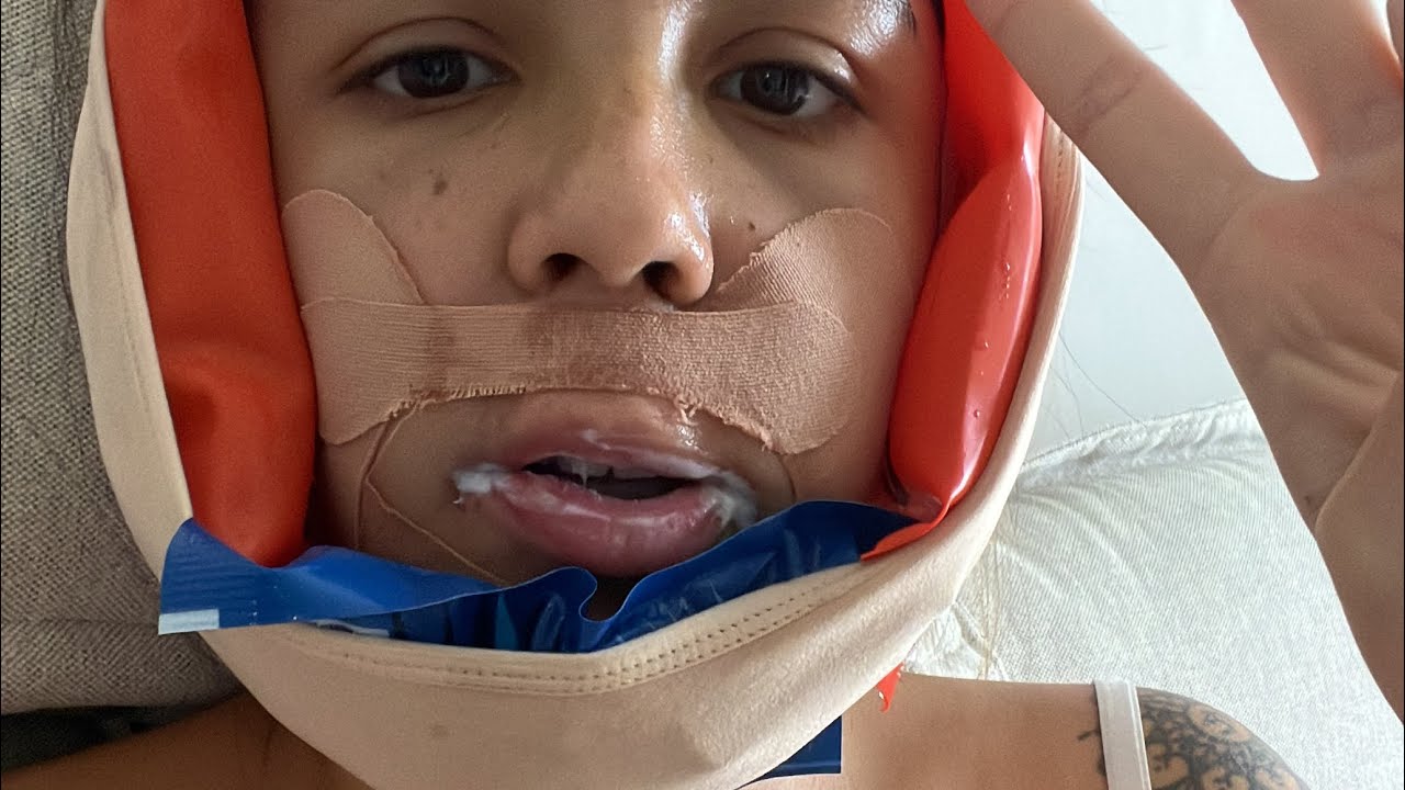 VLOG: CIRURGIA ORTOGNÁTICA E ATM (PRÉ OPERATÓRIO)