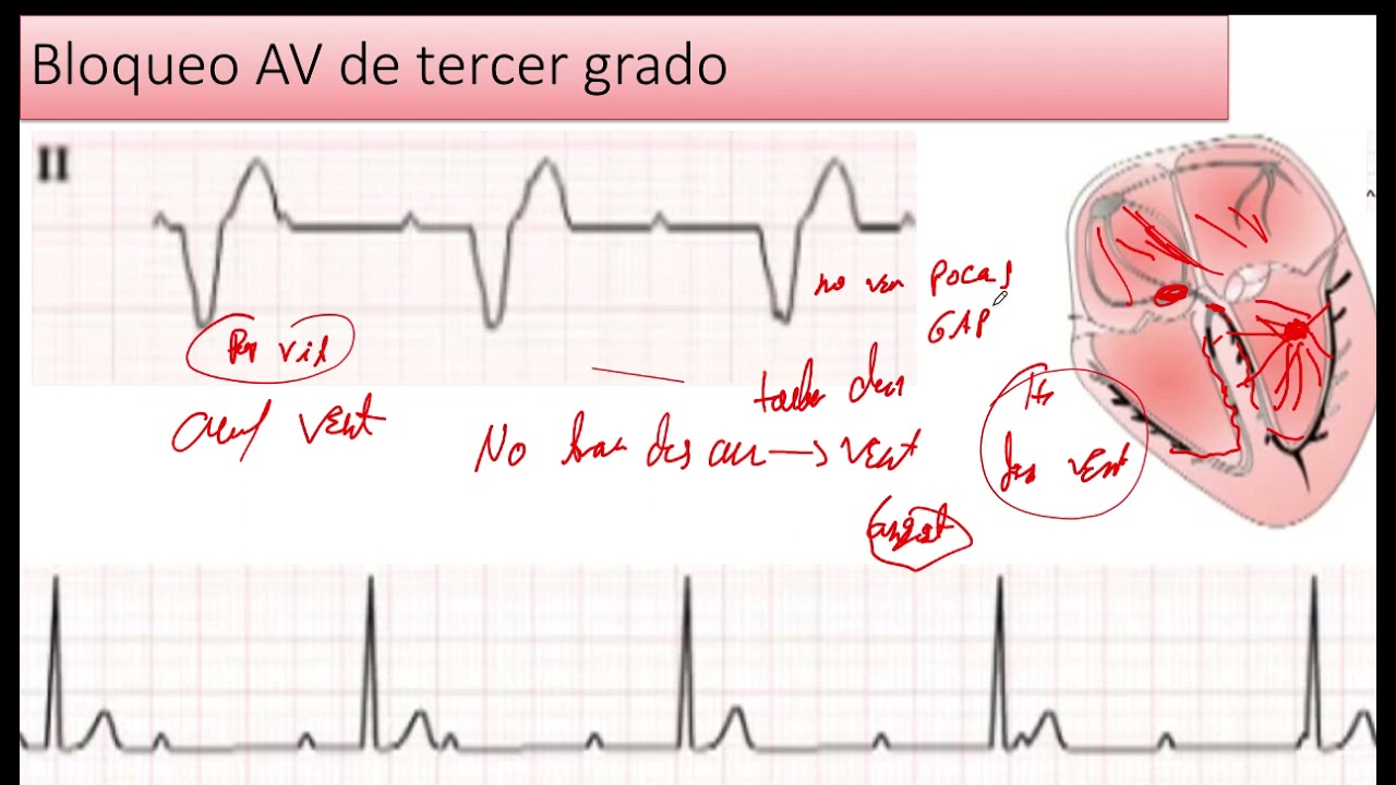 Bloqueo Auriculoventricular de Tercer Grado