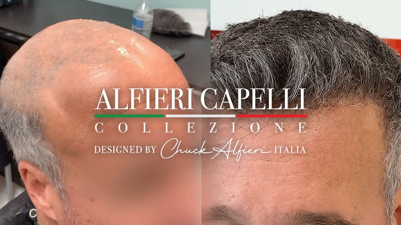 Chuck Alfieri Hair Replacement for Men and Women AMAZING