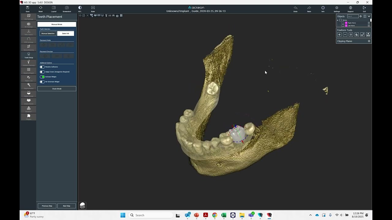 Crown Down Implant Plan - Acteon AIS / RealGuide Software