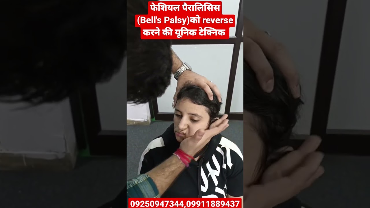 फेशियल पैरालिसिस (Bell's Palsy) के लिए यूनिक प्वाइंट || #facialparalysis #ytshorts #youtubeshorts