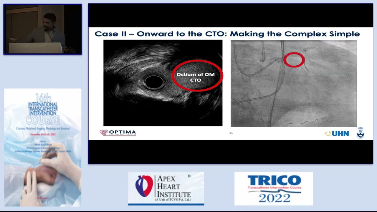 Using IVUS Imaging in Daily Practice: A Simple Step-by-Step Approach by Sanjog Kalra