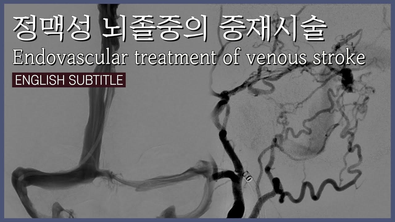 [뇌정맥뇌압] 정맥성 뇌졸중 (뇌정맥혈전증과 뇌경막동정맥루)의 신경 중재적 치료 Cerebral venous stroke: CVST and DAVF