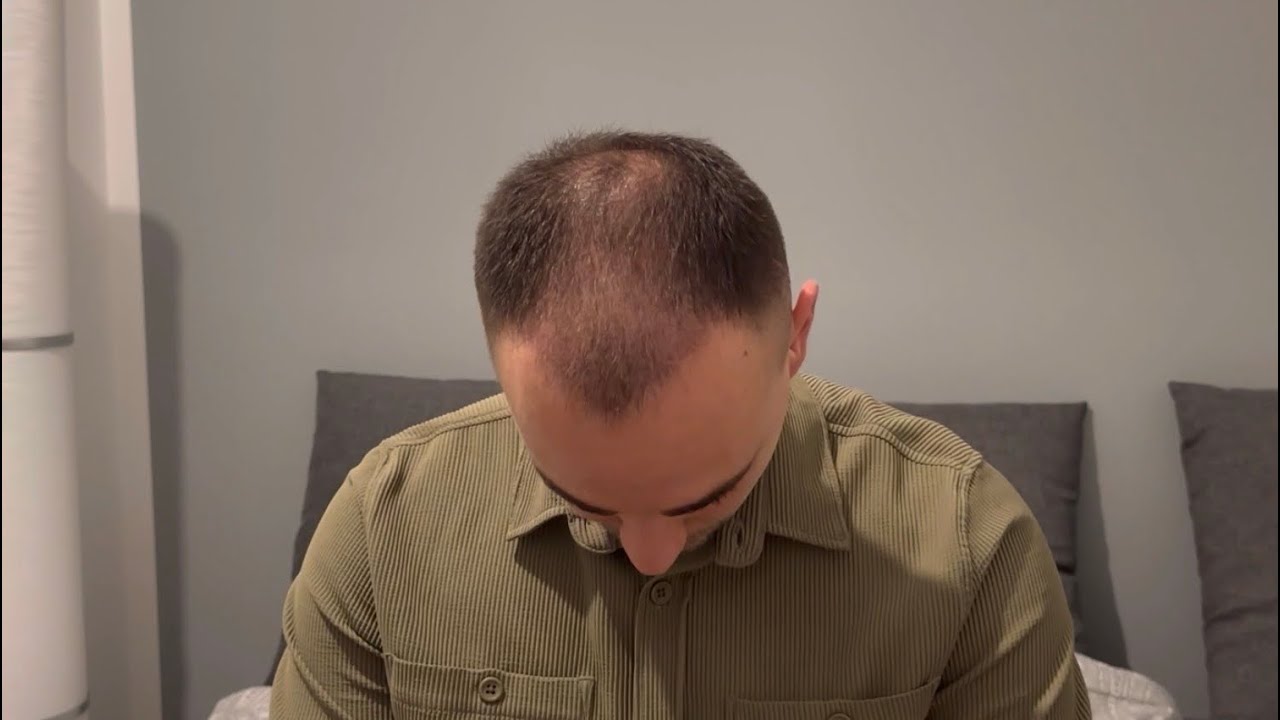 2 Monate nach Haartransplantation! Meine erste PRP Behandlung!