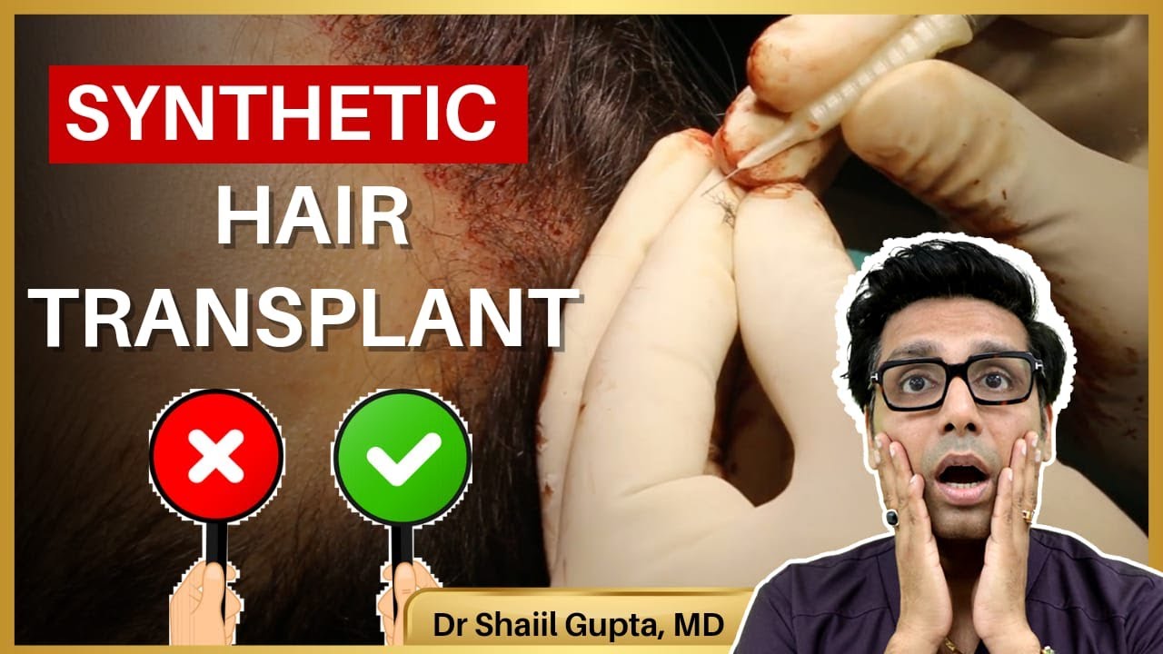 Synthetic Hair Transplant | Artificial Hair Transplant | Synthetic Hair Transplant results | Nido