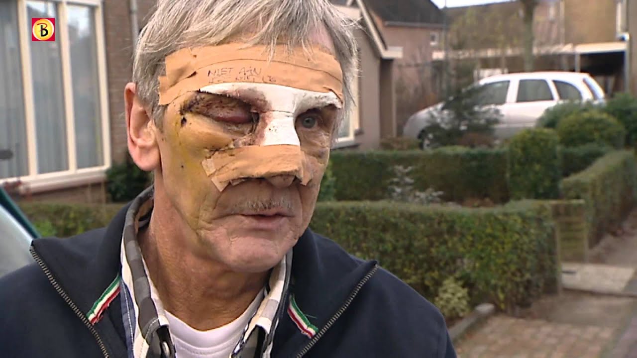 65-jarig vuurwerkslachtoffer mist oog