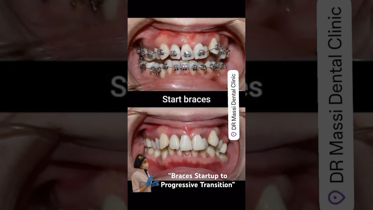&ldquo;Braces Startup to Progressive Transition&rdquo; 18 Months in #Braces #orthodontics #shorts