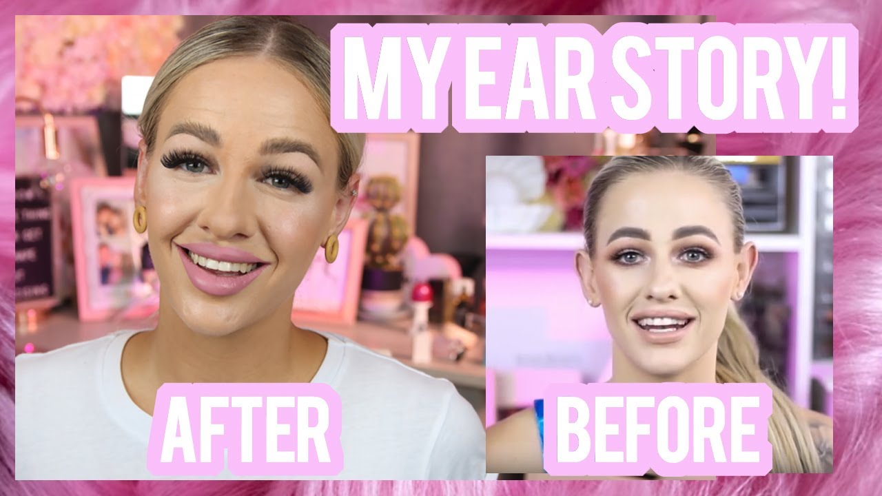 I HAD MY EARS PINNED BACK (NON SURGICAL OTOPLASTY)