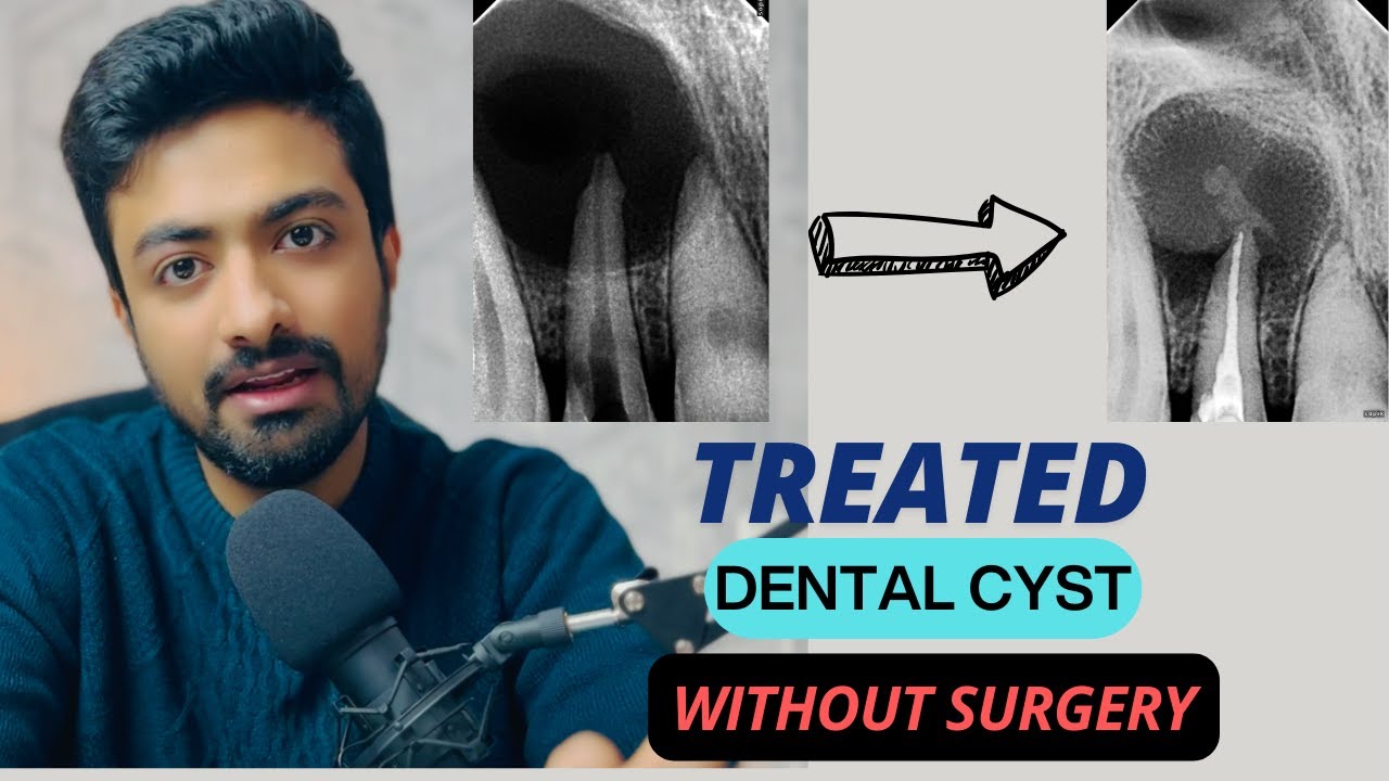 NON- SURGICAL TREATMENT OF PERIAPICAL CYST 