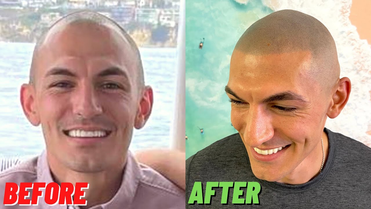 YOUTHFUL Scalp Micropigmentation Result in Los Angeles, CA