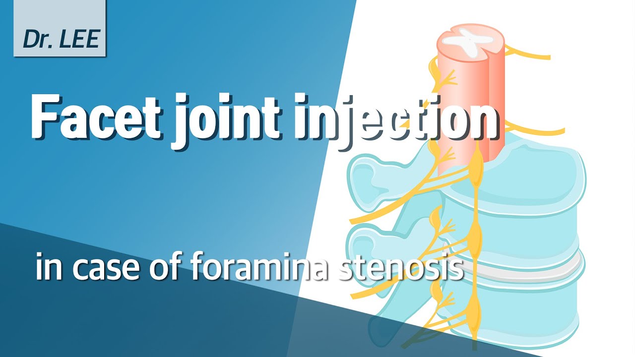Facet joint injection in case of foramina stenosis; technique and my logic, lumbar spine