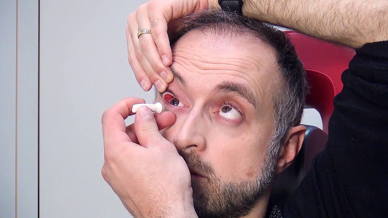 Rimozione con ventosa protesi oculare a guscio