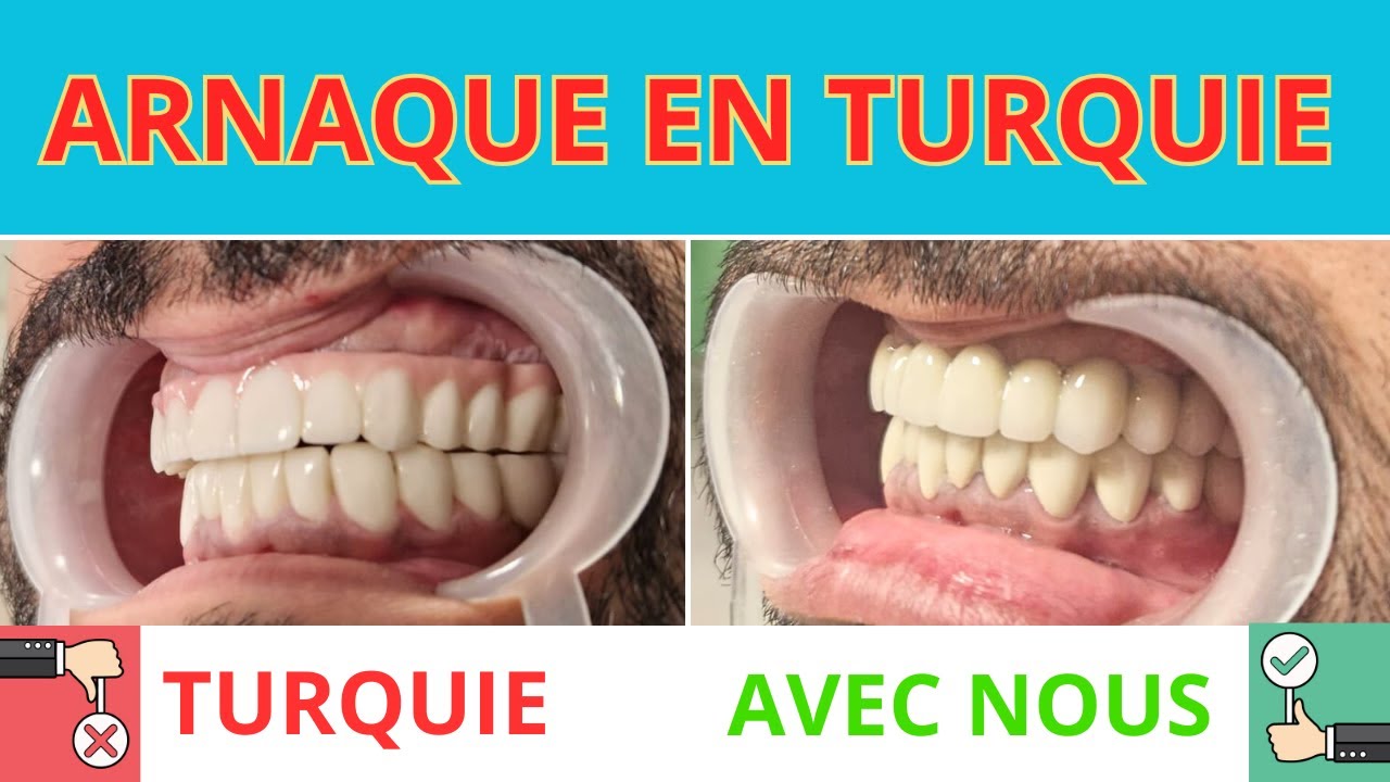 ARNAQUE EN TURQUIE ! 😱 #implantdentaire