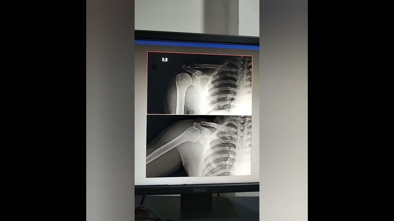 How to Read shoulder X ray in Fujifilm #medicos1k86 #radiology #radiography #radtech #xray #video 