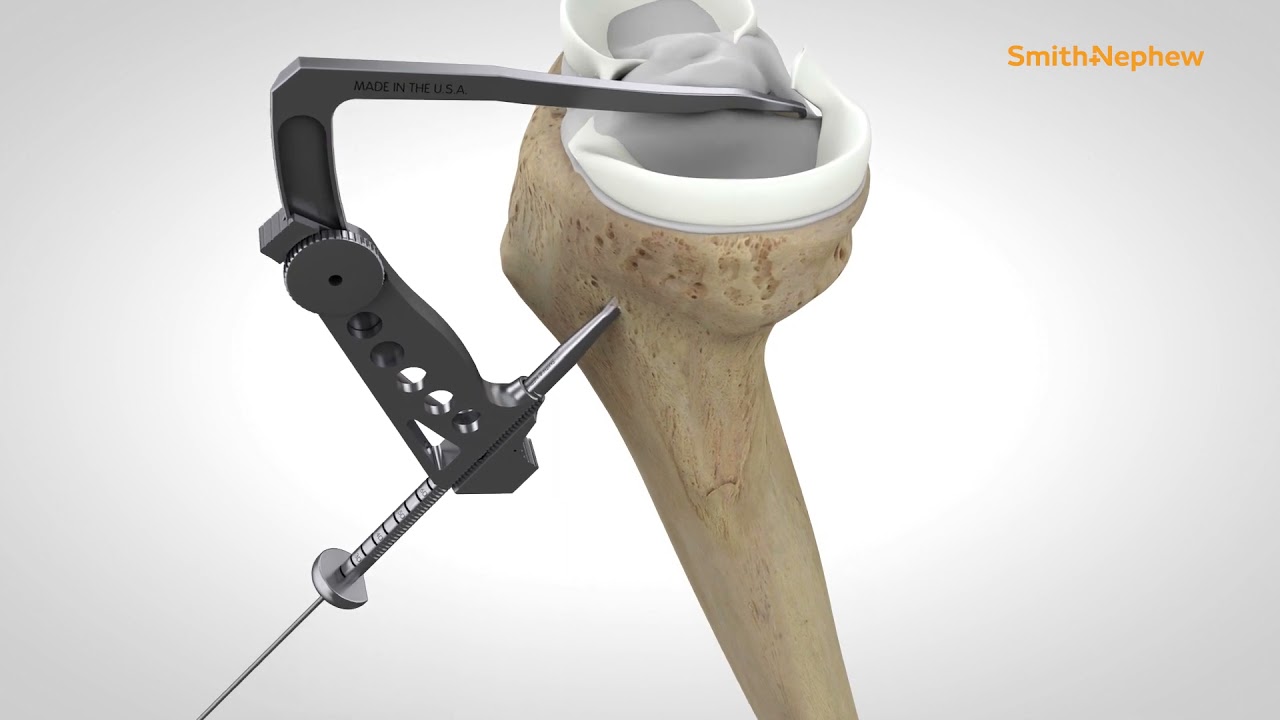 meniscal root tears repair