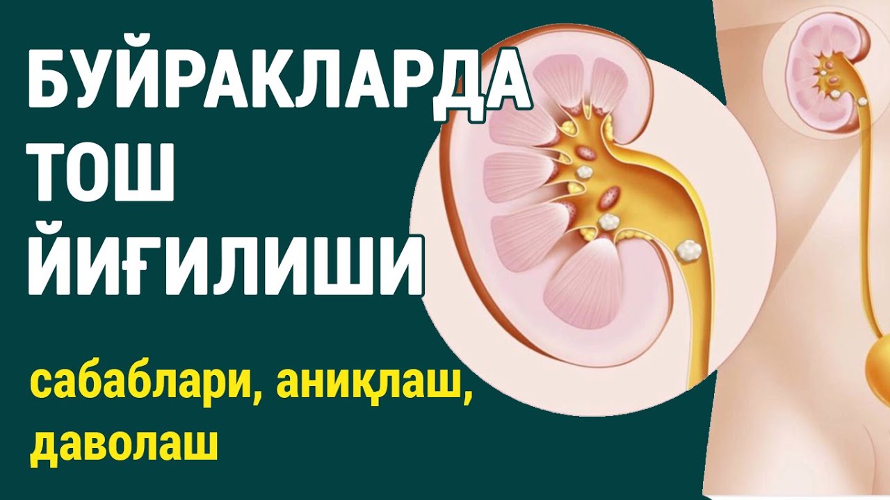 Буйракларда тош йиғилиши: сабаблари, аниқлаш ва даволаш