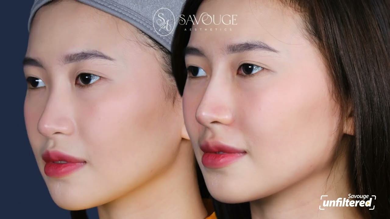 Hiko Nose Lift in just 15 minutes (NO SURGERY NEEDED!) | Ep 4: Picture Perfect for Gen Z Savvies