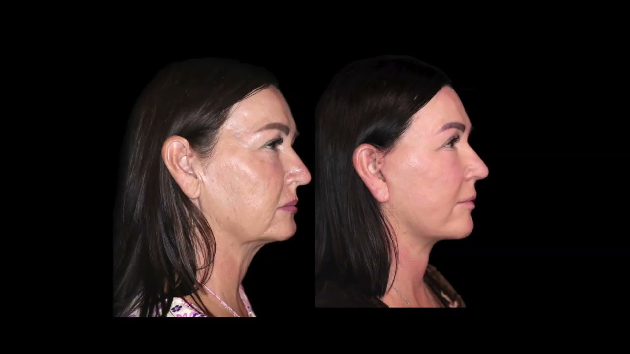 Before and after facelift with fat grafting