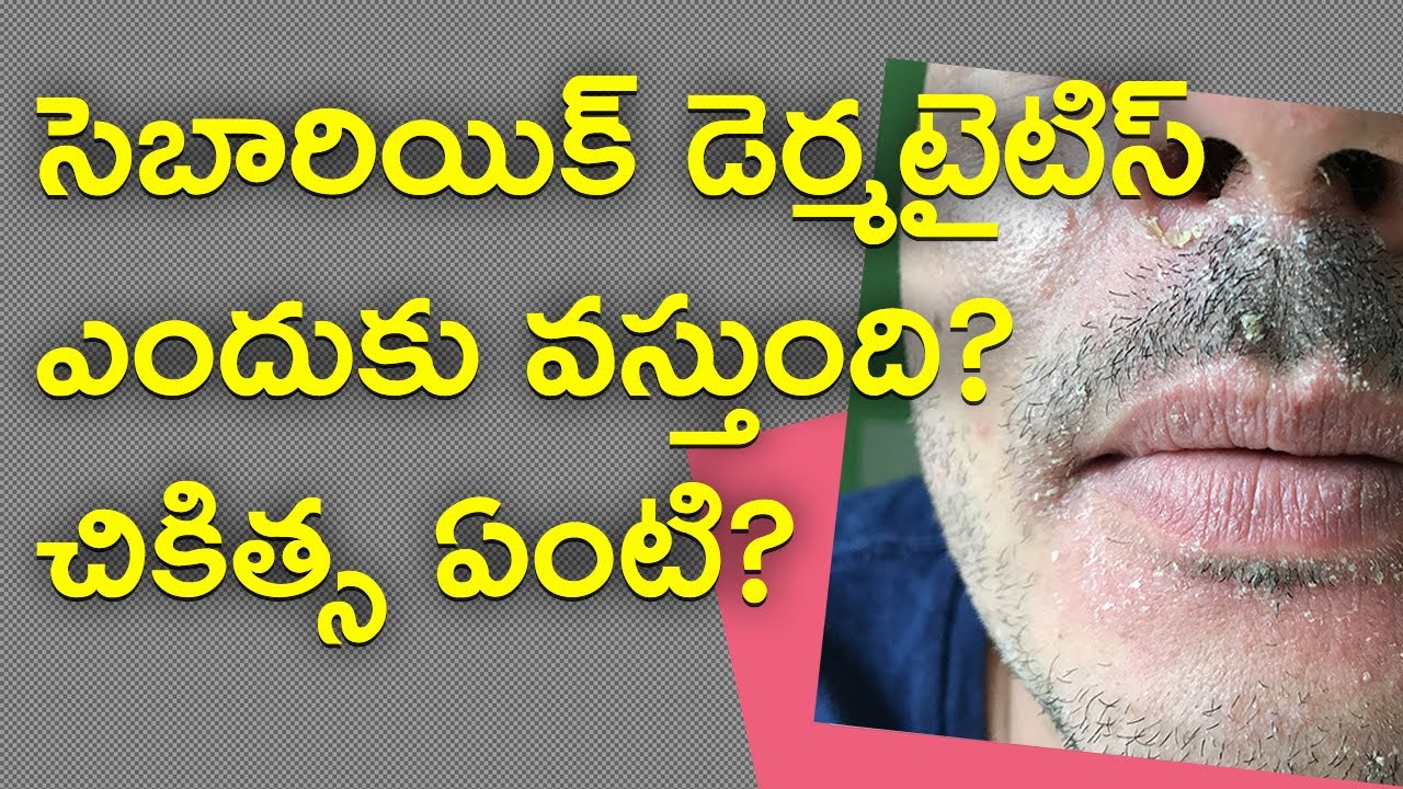 సెబారియిక్ డెర్మటైటిస్ ఎందుకు వస్తుంది? చికిత్స ఏంటి? Seborrheic Dermatitis Root Cause And Solution