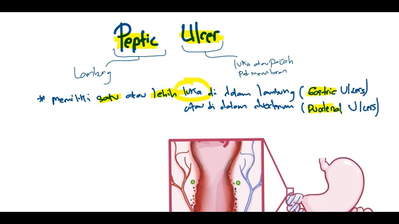 Patofisiologi - Tukak Lambung (Peptic Ulser)