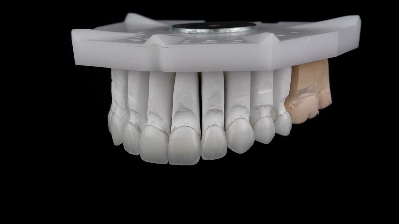 Charismatic Feldspathic Veneers