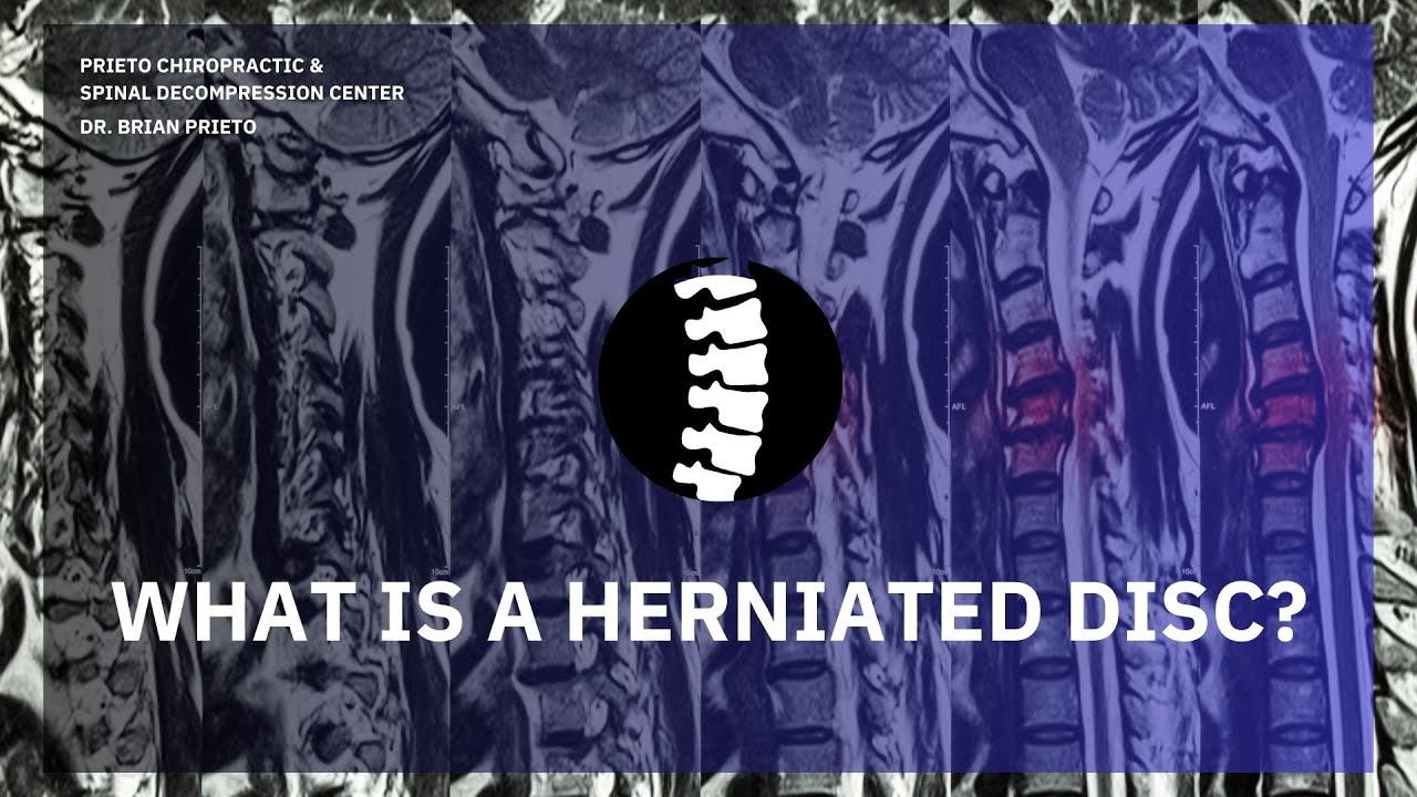 What Is A Herniated Disc? Yorba Linda CA Chiropractor