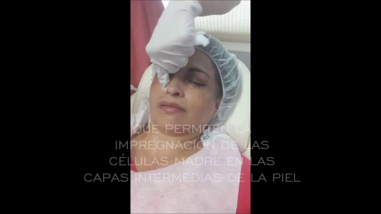 Aplicación de AAPE (Extractos de Células Madre Humanas) Dra Cristina Cortés - Dermatóloga