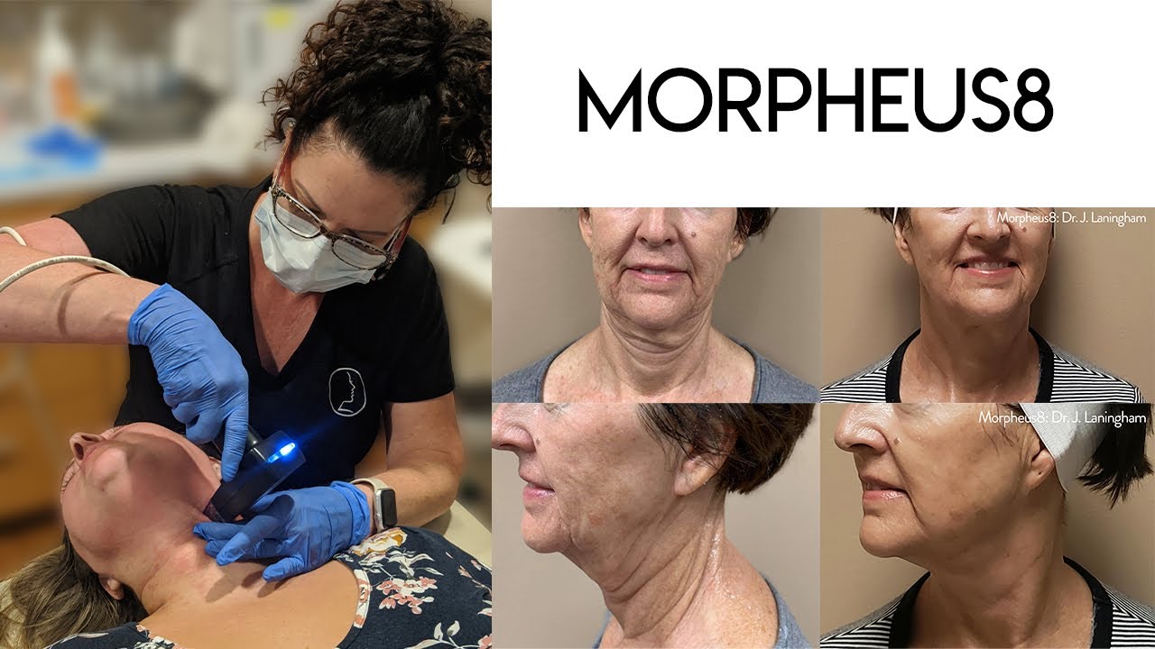 Morpheus8